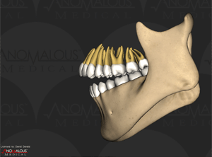 Mandible Distortions using 3D medical simulation software