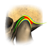Piper Classification of TMJ Derangements